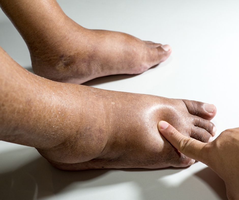 Lymphatic System Pitting Edema Detail